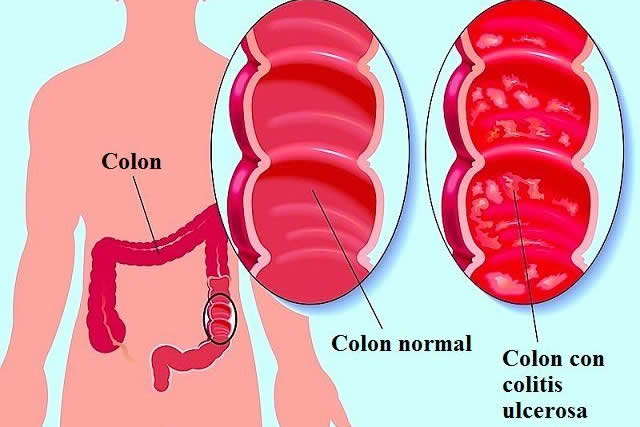 colitis cronica
