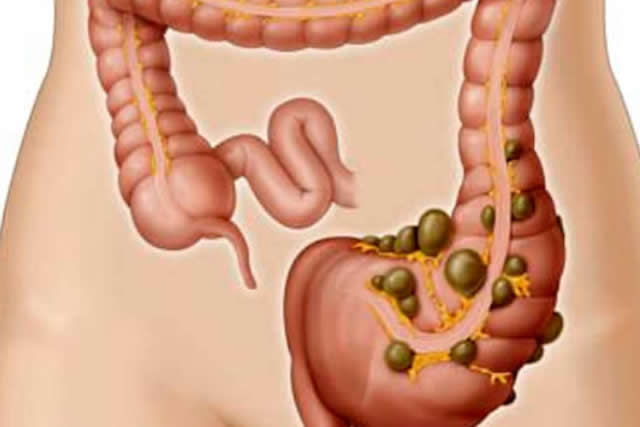 diverticulos de colon 
