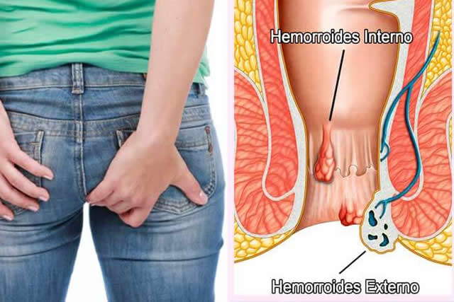 hemorroides quito