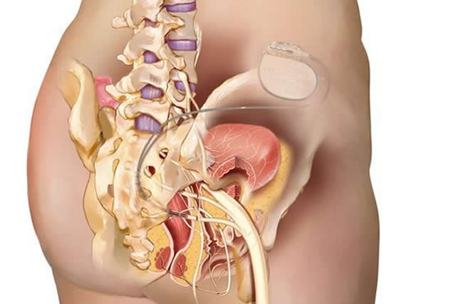 neuromodulacion sacra