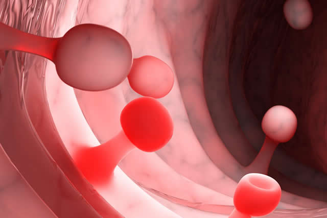 polipos en colon y recto