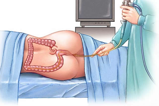 rectosigmoidoscopia