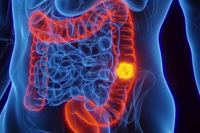 tratamiento colon recto ano