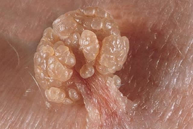 vph verrugas anales